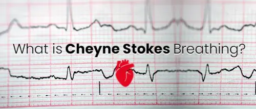 What is Cheyne Stokes Breathing?