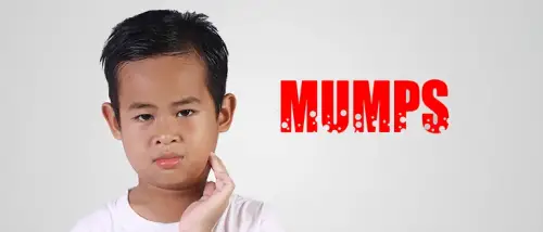 Understanding Mumps: A Viral Disease