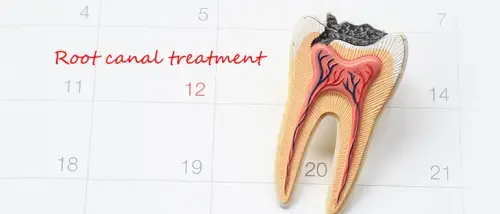 Root Canal Treatment: Purpose, Procedure & Risks