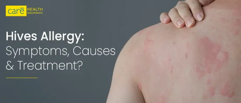 Hives Allergy: What are the Symptoms, Causes and Treatment?